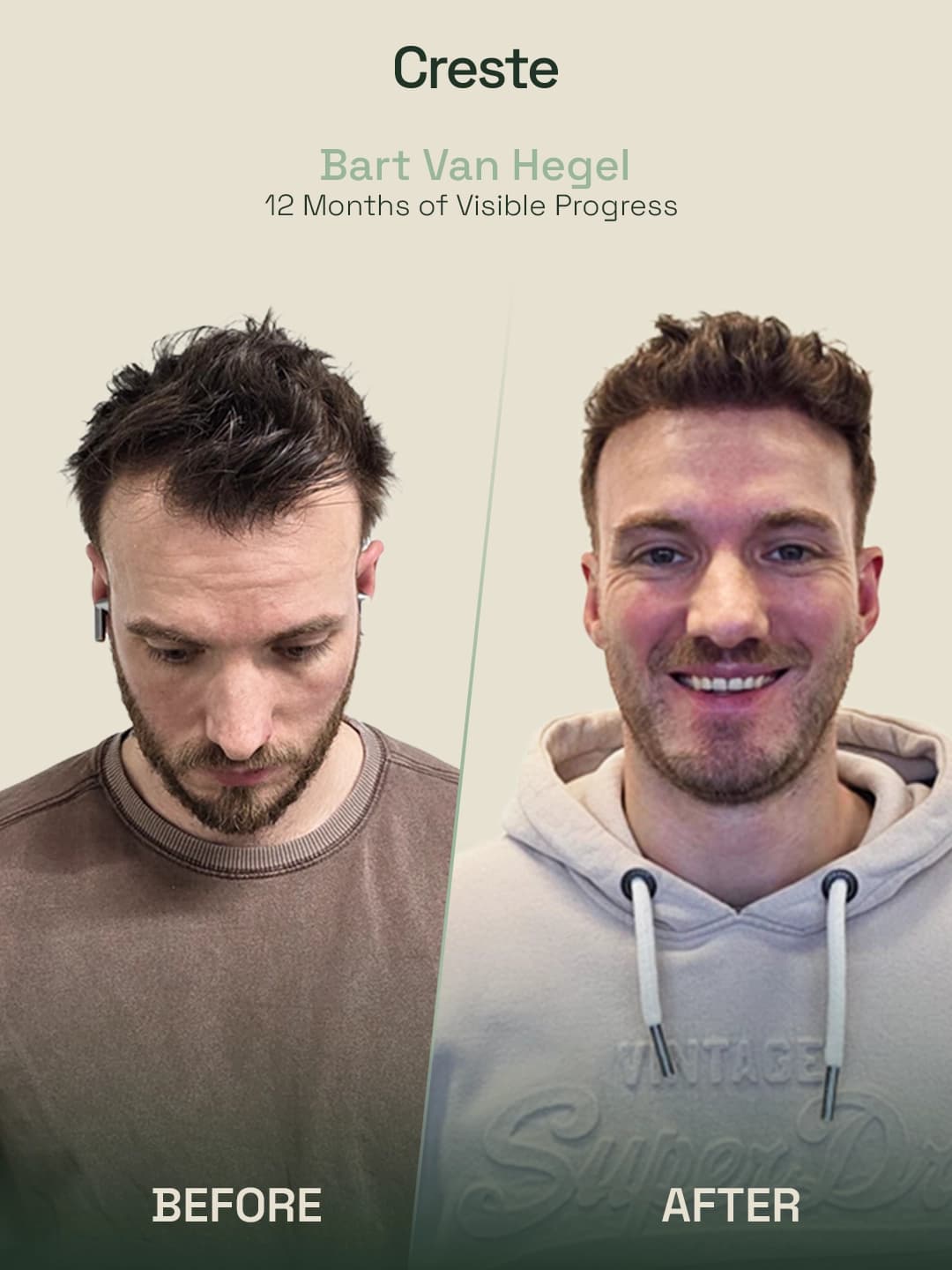 Bart Van Hegel — 12-month hairline restoration before and after result