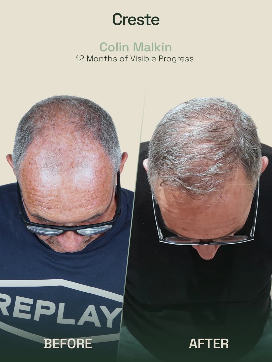 Colin Malkin — 12-month crown and density hair restoration before and after