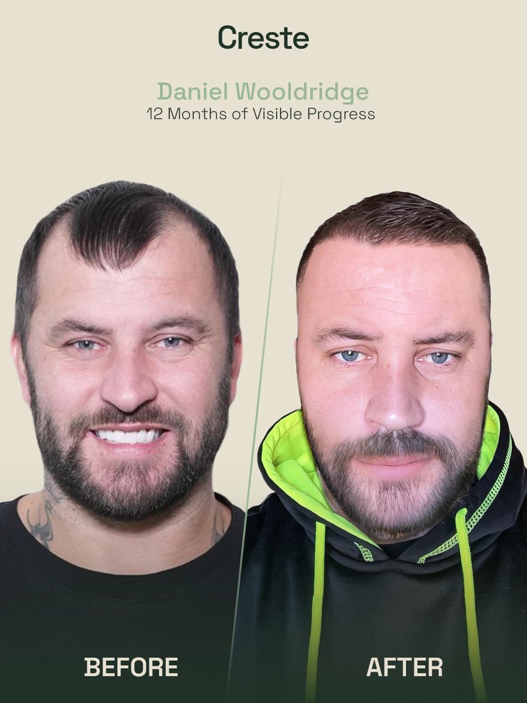 Daniel Wooldridge — 12-month frontal hairline lowering before and after result