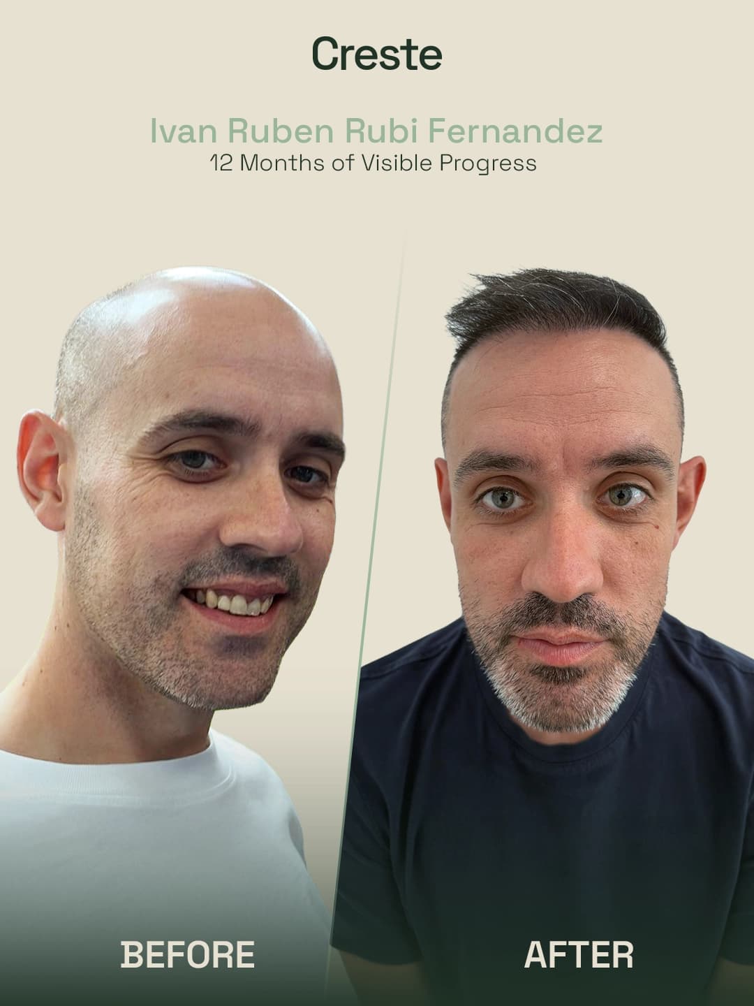 Ivan Ruben Rubi Fernandez — 12-month Norwood stage restoration result