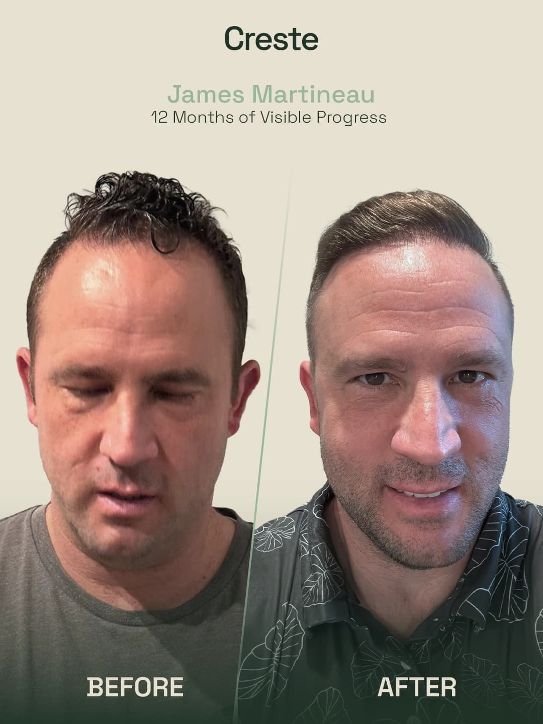 James Martineau — 12-month FUE hair transplant transformation before and after