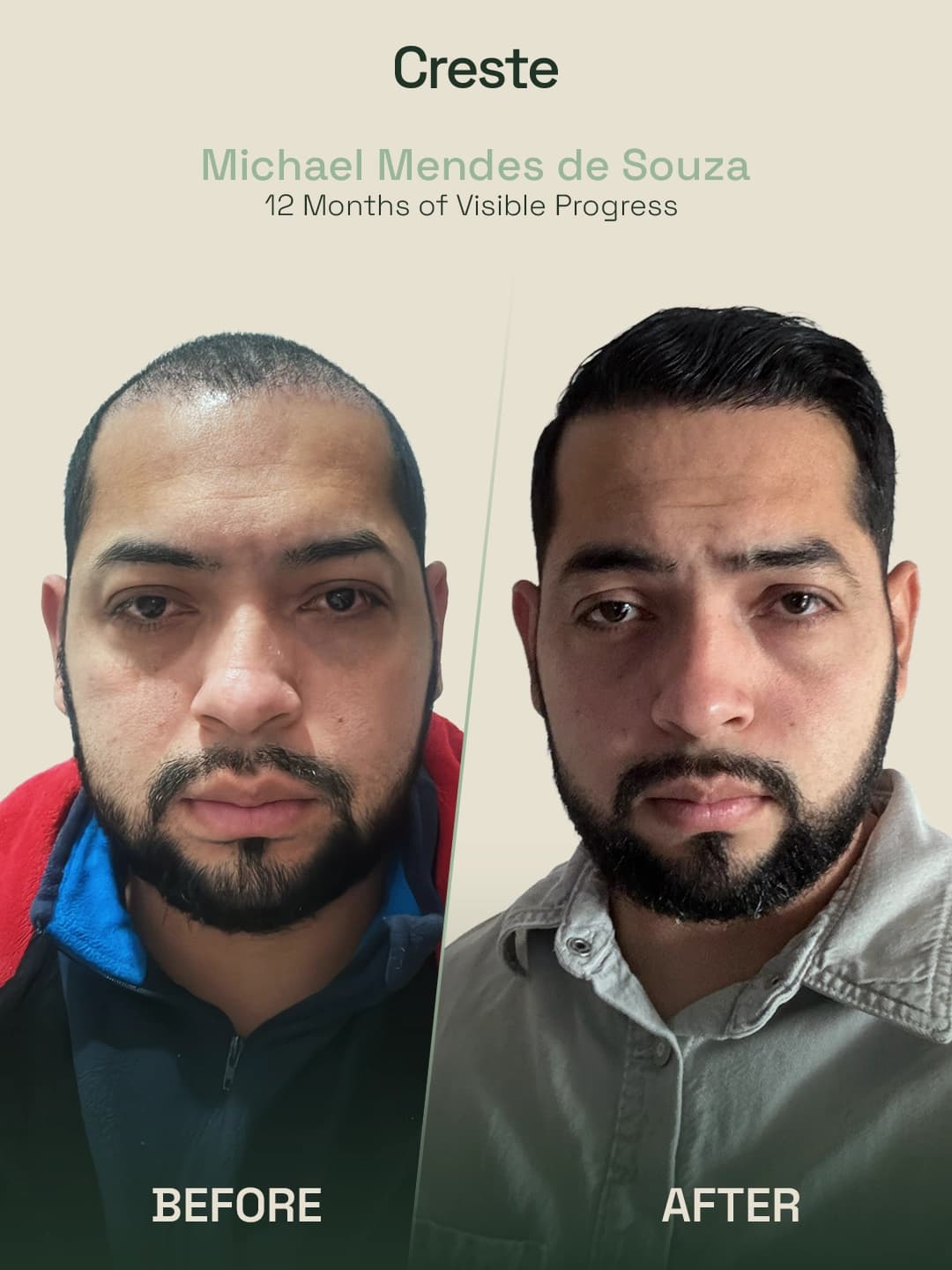 Michael Mendes de Souza — 12-month DHI graft placement result