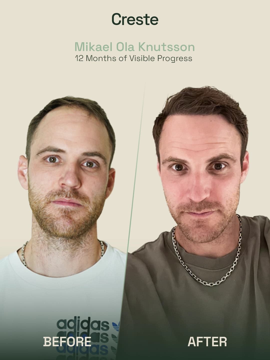Mikael Ola Knutsson — 12-month temple and crown restoration result